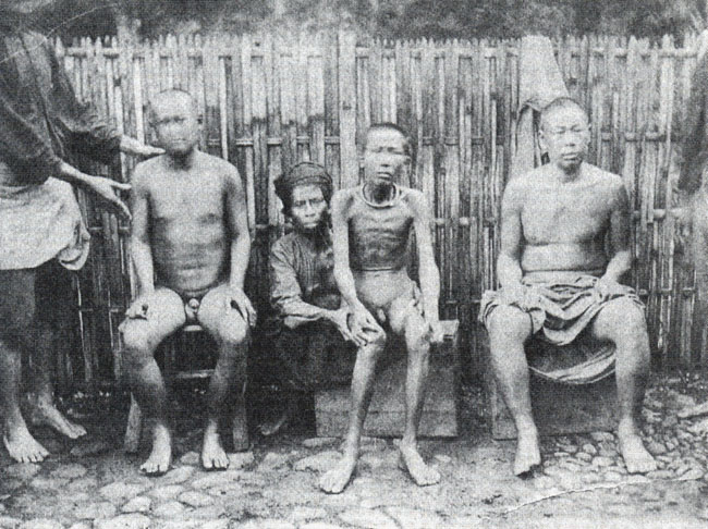 beriberi patients